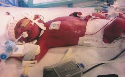 Bebê prematuro nasce com 0,5 kg