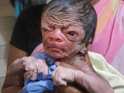 Menino ‘Benjamin Button’ nasce em Bangladesh‏