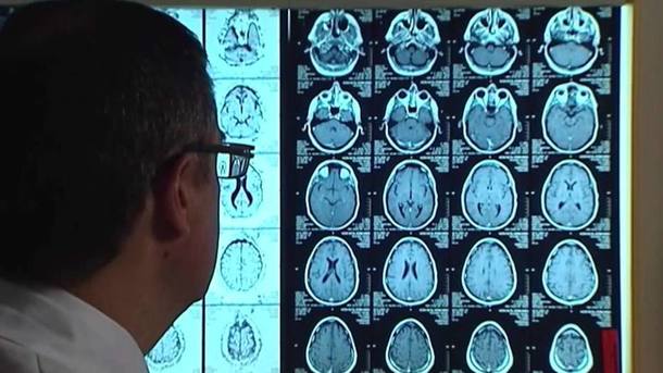 Estudo indica aspirina contra o Alzheimer