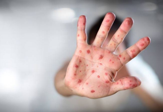 Casos suspeitos de sarampo interditarão USFs por duas horas em Garça