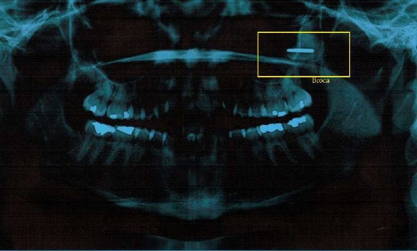 Dentista perde broca em boca de paciente pela segunda vez