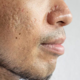 Acne severa impacta a saúde da pele, gera constrangimentos e pode acarretar empecilhos