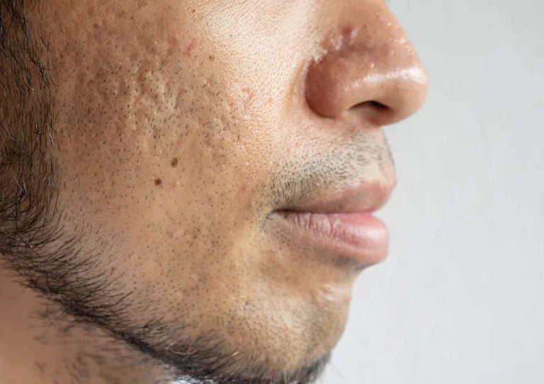 Acne severa impacta a saúde da pele, gera constrangimentos e pode acarretar empecilhos