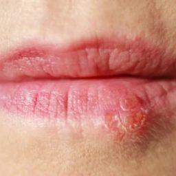 De herpes à surdez, saiba quais são os riscos e as consequências de um beijo
