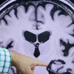 Novo componente genético ligado ao Alzheimer é descoberto em estudo