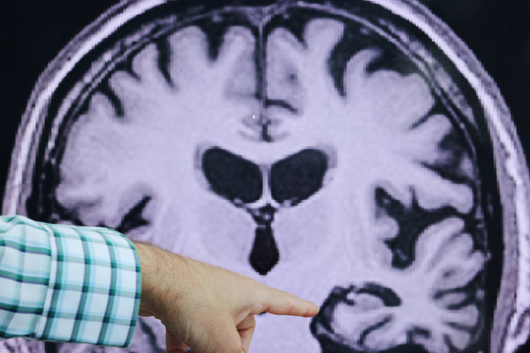 Novo componente genético ligado ao Alzheimer é descoberto em estudo