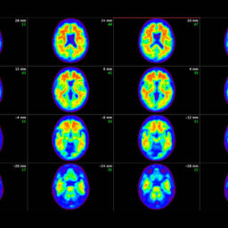 Exame de sangue detecta Alzheimer com mais precisão do que médicos, diz estudo