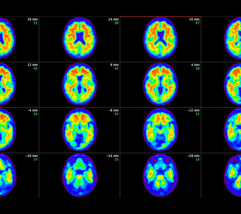 Exame de sangue detecta Alzheimer com mais precisão do que médicos, diz estudo