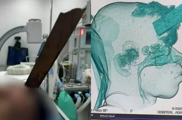 Trabalhador sobrevive após ficar com estaca encravada na cabeça no RJ