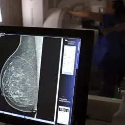 Ministério da Saúde passa a recomendar mamografia a partir dos 40 anos