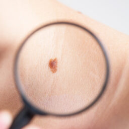 Casos de câncer de pele dobram em Marília em quatro anos