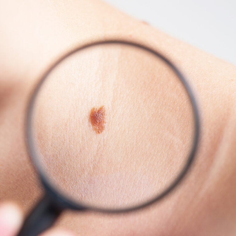 Casos de câncer de pele dobram em Marília em quatro anos