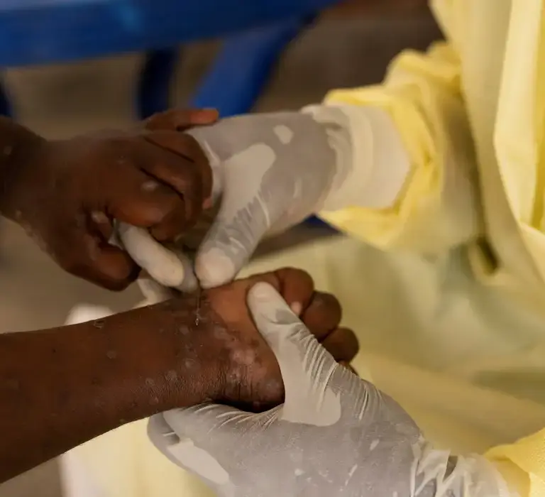 Brasil registra 88 casos de Mpox em 2026; saiba como evitar a doença