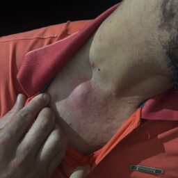 Presença de escorpiões gera preocupação na CPJ; preso na carceragem sofre picada