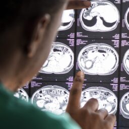 Marília registra 489 atendimentos por AVC e 174 por infarto em 2025