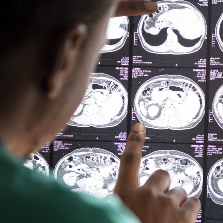 Marília registra 489 atendimentos por AVC e 174 por infarto em 2025