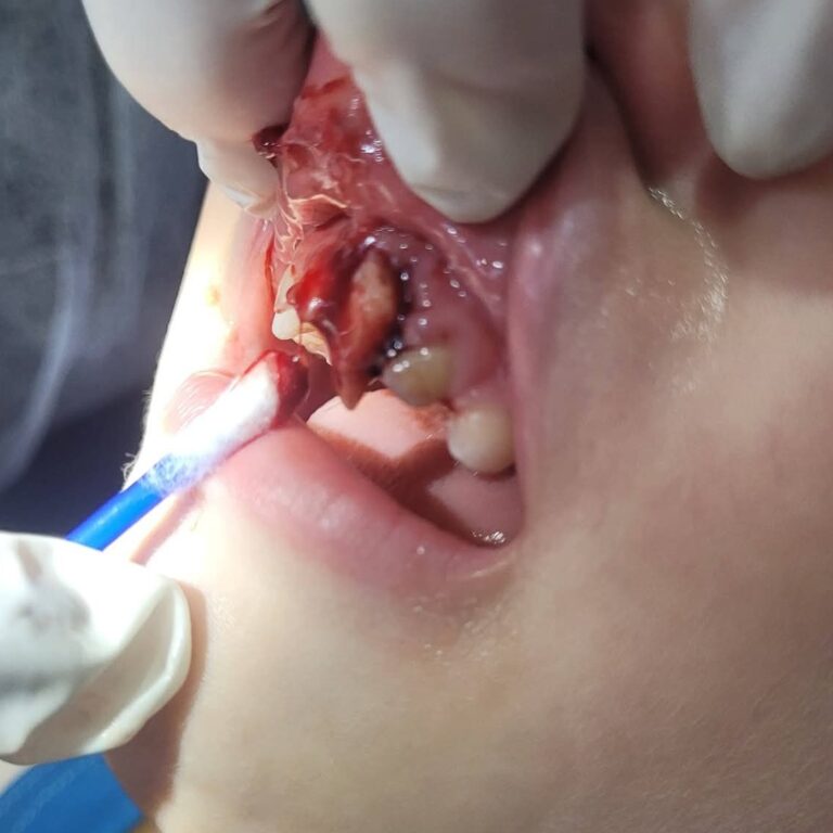 Criança perde dente após acidente em escola; Prefeitura se posiciona